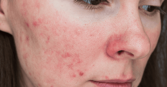 Rosacea Suffering Face