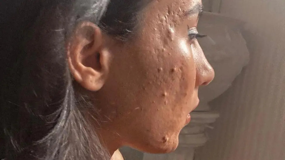 Living hell for 'forgotten' skin patients
