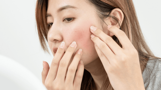 Natural Skincare for Rosacea