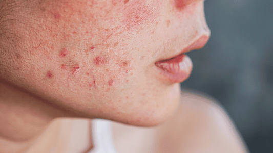 Natural Skincare for Reducing Redness and Inflammation