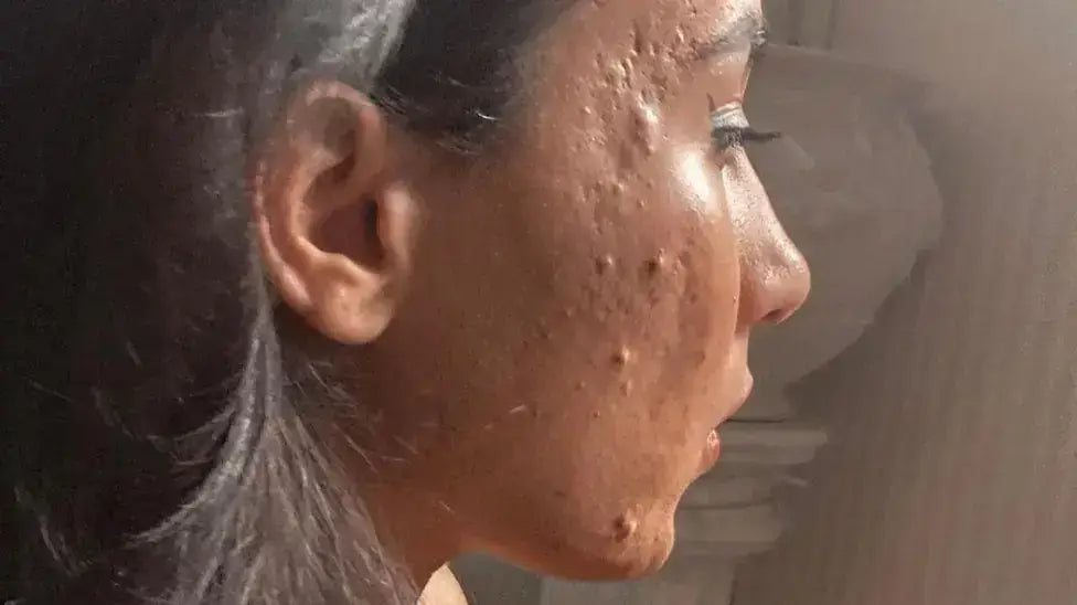 Profile view of a woman with skin issues highlighting the Living Hell faced by forgotten skin patients.