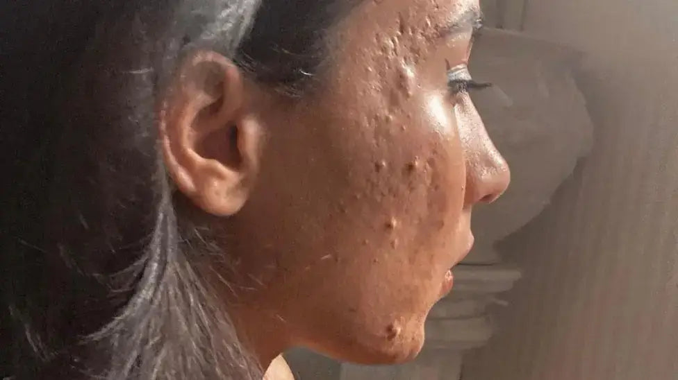 Profile view of a woman with skin issues highlighting the Living Hell faced by forgotten skin patients.