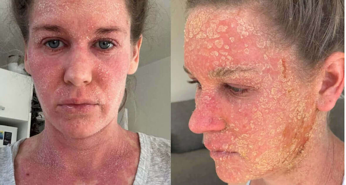 TSWS Topical Steroid Withdrawal Syndrome